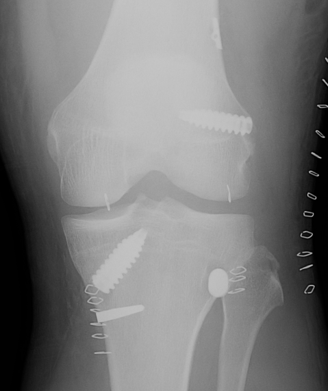 ACL and posterolateral corner